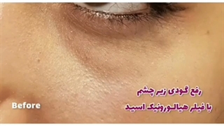 رفع گودی زیر چشم با فیلر هیالورونیک اسید