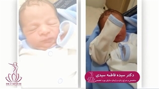 زایمان سزارین