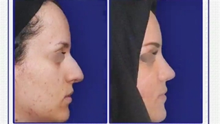 جراحی زیبایی بینی | دکتر خوروش