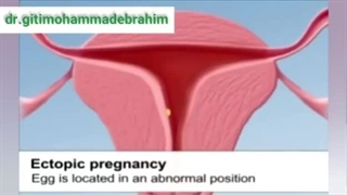 حاملگی خارج از رحم چگونه اتفاق می افتد ؟
