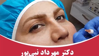 رفع گودی زیر چشم