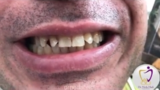 انجام کار زیبایی دندان برای مراجعه کننده عزیز