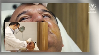تزریق ژل خط خنده و زیرچشم
