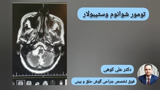 تومور شوانوم وستیبولار