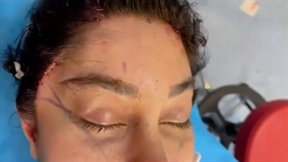 فیلم بدون سانسور جراحی همزمان لیفت آندوسکوپی ابرو و شقیقه و لیفت سانترال لب بالا