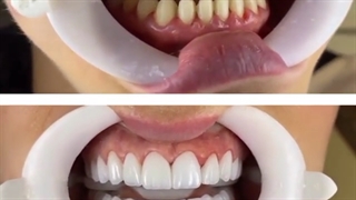 زیبایی دندان