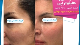 هایفوتراپی لیفت پیشانی