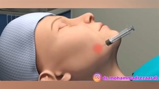 جراحی لیفت صورت چگونه انجام می شود؟
