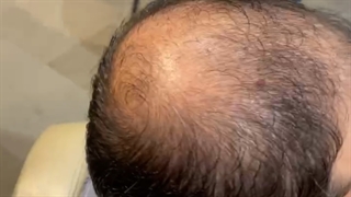 کاشت موی موقت یکروزه09126074167