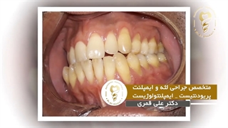 فیلم جراحی پیوند لثه ۵ دندان در فک پایین