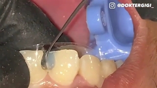 ترمیم دندان با کامپوزیت