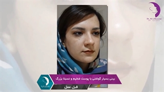 عمل بینی گوشتی با پوست ضخیم