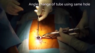 انجام عمل جراحی ناهنجاری اسکولیوز