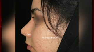 عمل زیبایی بینی | دکتر ابراهیمی
