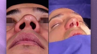 جراحی بینی مردانه و اصلاح کجی بینی | دکتر رضا رفیع