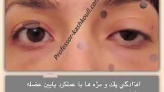 جراحی افتادگی پلک و مژه ها با عملکرد پایین عضله | پروفسور کشکولی