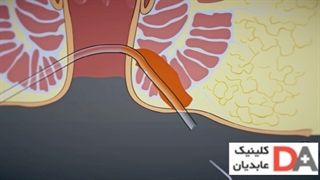 درمان فیستول با لیزر - کلینیک عابدیان
