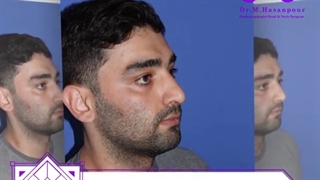 بلافاصله بعد از برداشتن گچ بینی