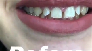 اصلاح طرح لبخند