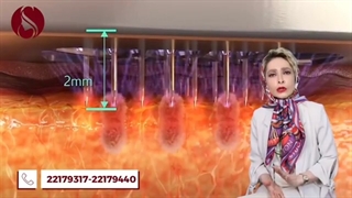 سن مناسب برای انجام آر اف سوزنی