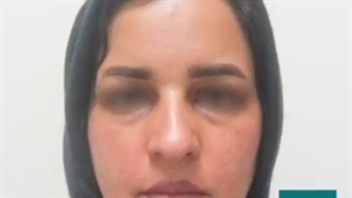 نمونه ای از جراحی بینی طبیعی و لیفت پیشانی