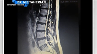 آندوسکوپی دیسک کمر از ناحیه پهلو | متخصص ازتوپد | دکتر محمد ابراهیم طاهریان پروتز دندان