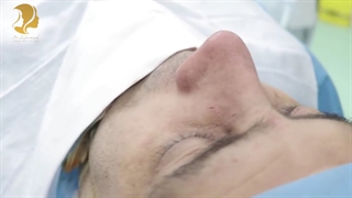 فیلم ترمیم بینی