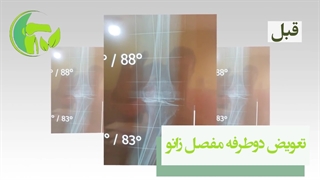 قبل و بعد از جراحی تعویض دو طرفه مفصل زانو
