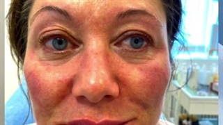 رضایت بیمار سوئدی از تزریق بوتاکس در کلینیک امبرس سوئد