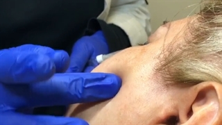 جوانسازی صورت خانم مسن با تزریق ژل