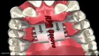 بازکردن پیچ هایرکسبازکردن پیچ هایرکس