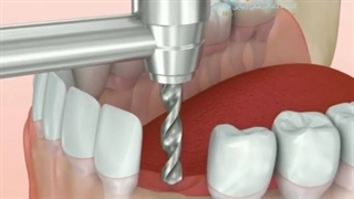 آیا جراحی ایمپلنت دندان درد دارد ؟