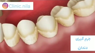جرم‌گیری دندان