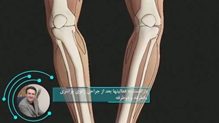 چه زمانی بعد از جراحی زانوی پرانتزی می توان به فعالیت بازگشت؟