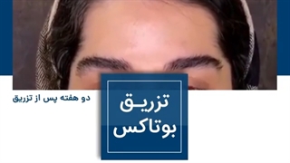نمونه تزریق بوتاکس پیشانی