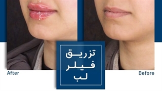 نمونه تزریق ژل لب