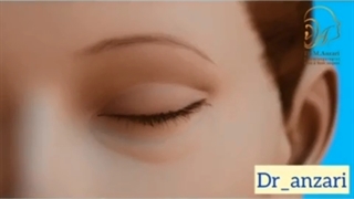 انیمیشن جراحی بلفاروپلاستی