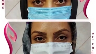 قبل و بعد از عمل جراحی پلک