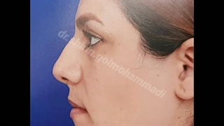 جراحی زیبایی بینی