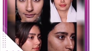 جراحی زیبایی بینی و نتیجه بعد از آن