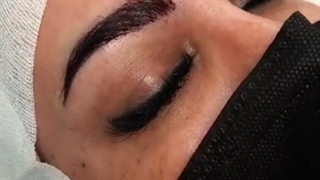 فیلم واقعی کاشت ابرو| کلینیک ابروان