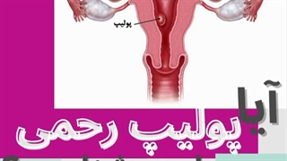 پولیپ رحمی چیست؟ برای درمان آن چکار کنیم؟