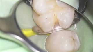 ترمیم دندان با کامپوزیت