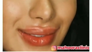 فیلم تزریق ژل لب طبیعی نچرال