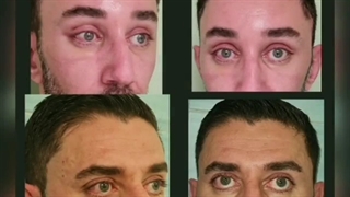 فیلم لیفت اندوسکوپی پیشانی و ابرو برای آقای جوان