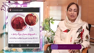 توضیحات و عکس از خارج کردن فیبروم های بزرگ رحم