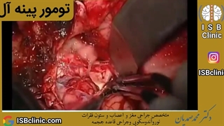 تومور پینه آل (غده صنوبری)