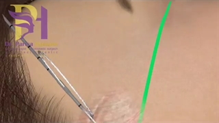 انیمیشنی از جراحی چشم گربه ای