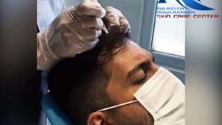 فیلم انجام مزوتراپی مو برای آقایان