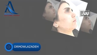 فیلم واقعی تزریق چربی به صورت